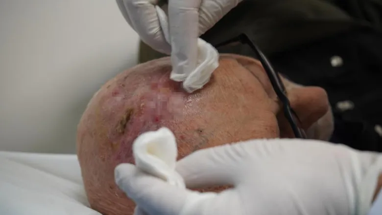 Dünyada üçüncü kez görülen nadir tümör tedavi edildi