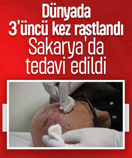 Dünyada üçüncü kez görülen nadir tümör tedavi edildi