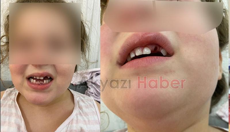 Kız çocuğu bozuk yolda düştü, dişleri kırıldı