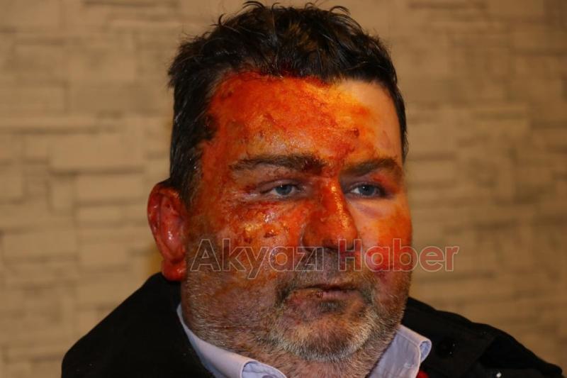 Uyurken yüzünü yaktı