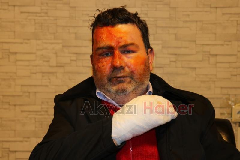 Uyurken yüzünü yaktı