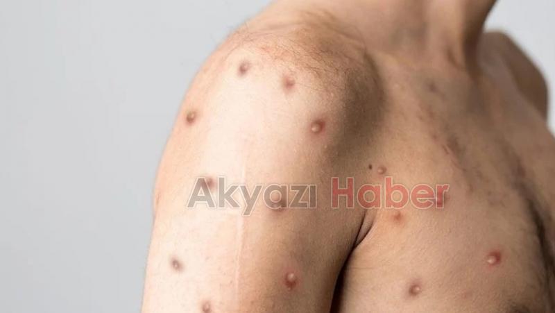 Maymun çiçeğinde semptomlar değişiyor