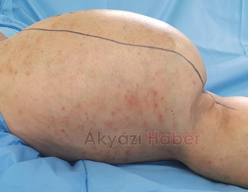 Bacağında devasa boyutta tümör oluştu