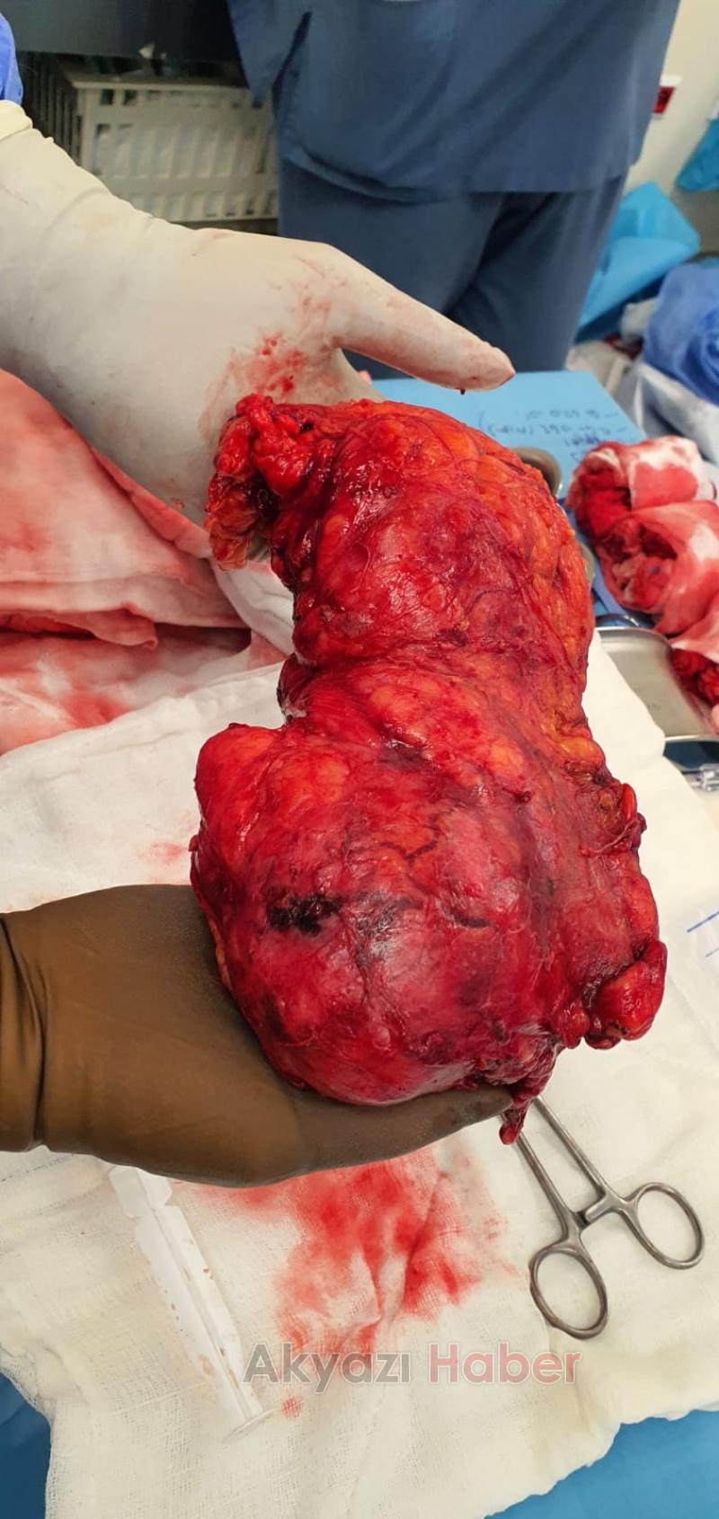 SEAH’ta Üroloji Kliniğinden bir ilk daha