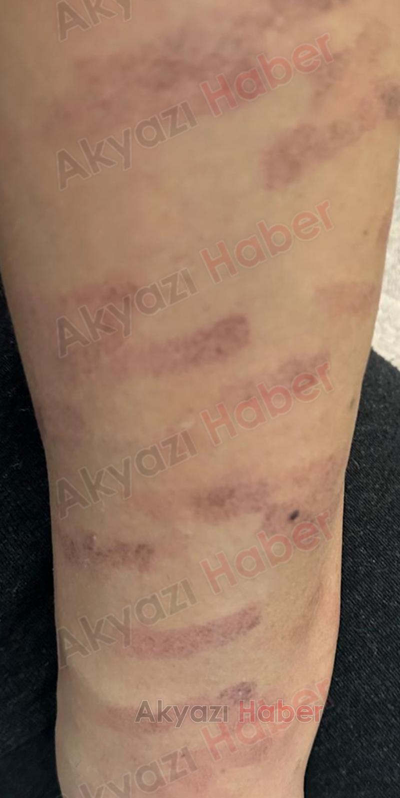 Lazer epilasyonda vücudu yandı