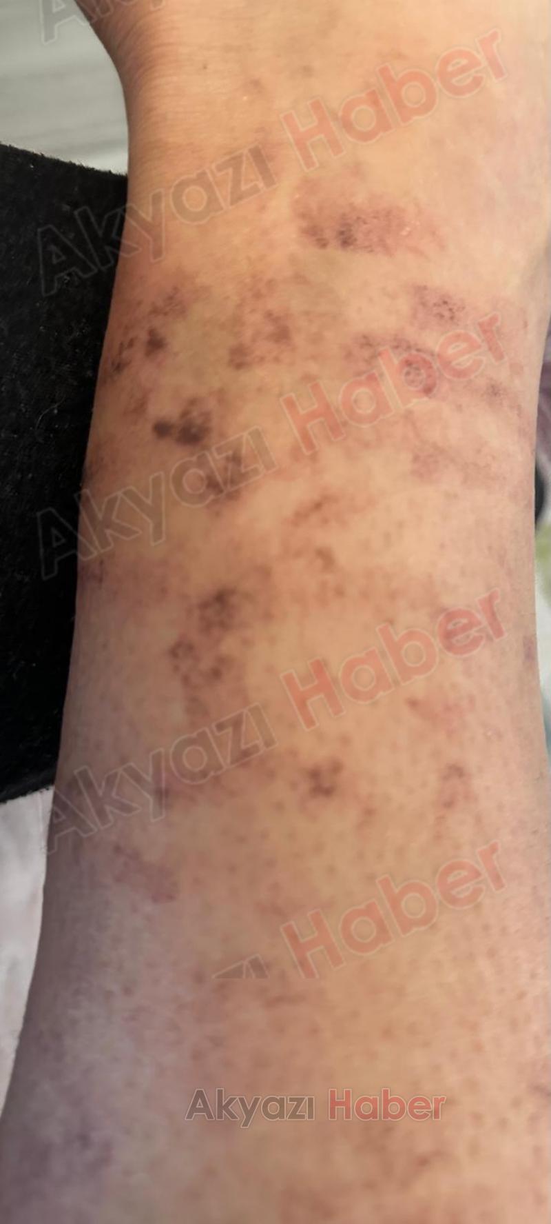 Lazer epilasyonda vücudu yandı