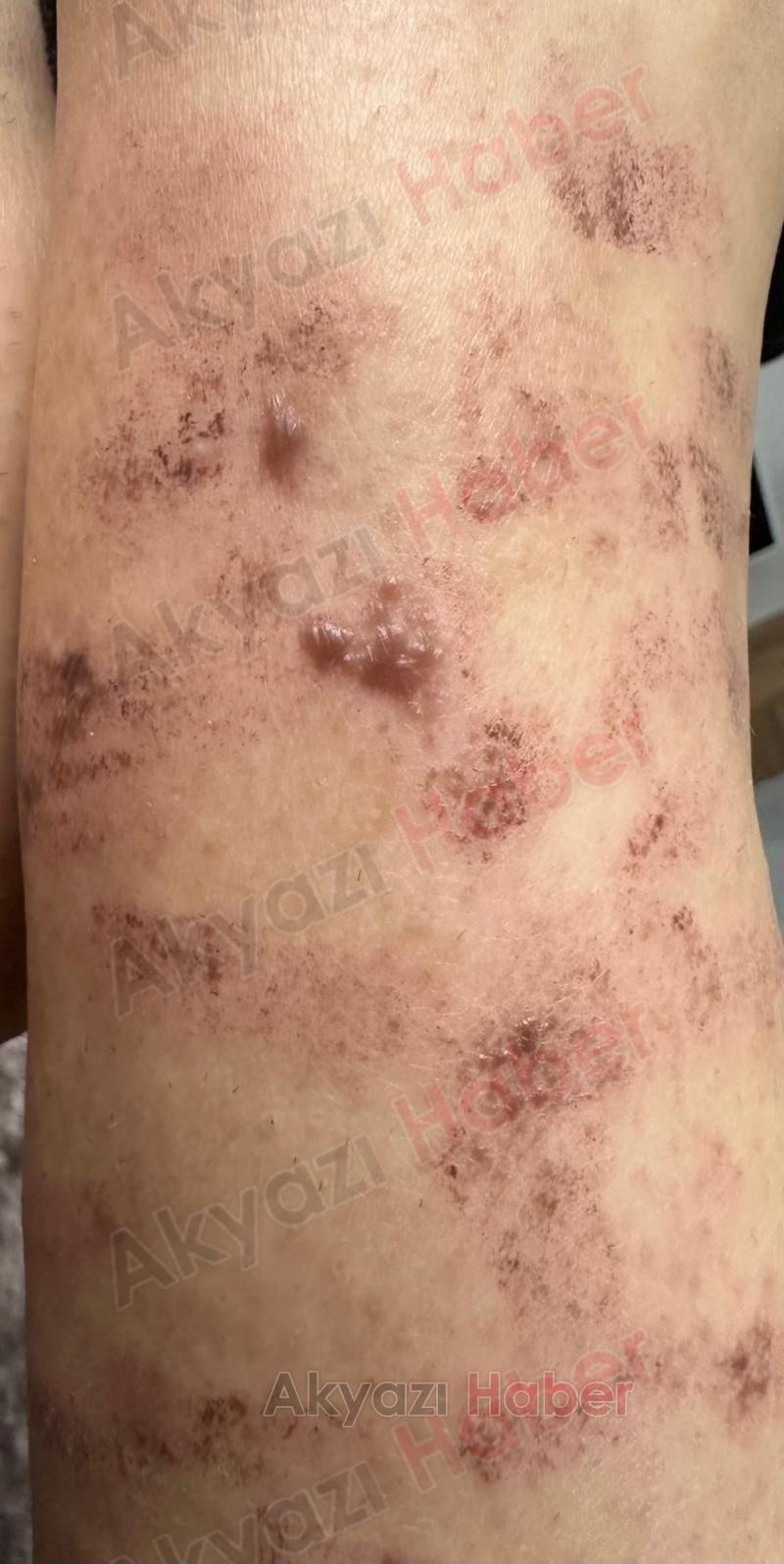 Lazer epilasyonda vücudu yandı