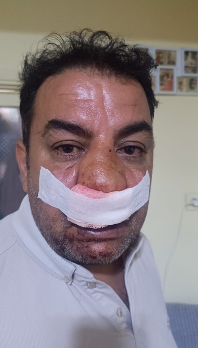 Fahiş fiyata karşı çıkan tur şoförünün burnunu kırdılar