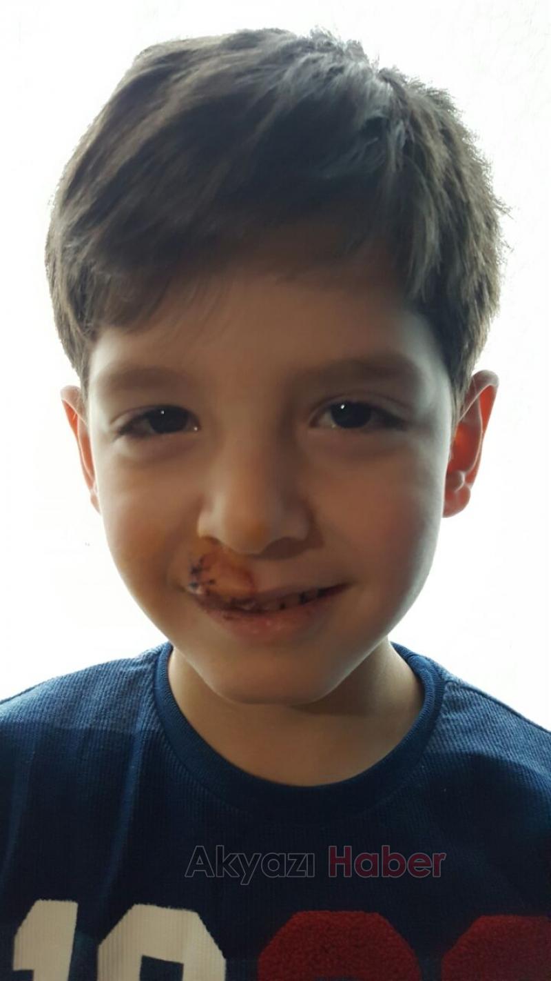 Küçük Çocuğun Dişleri Damağından Çıktı 