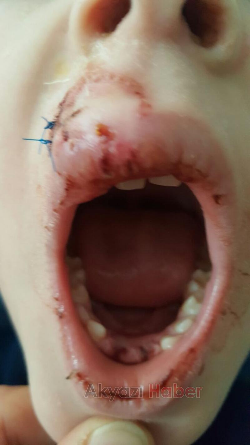 Küçük Çocuğun Dişleri Damağından Çıktı 