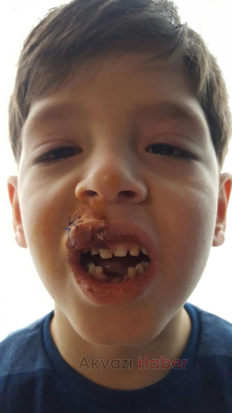 Küçük Çocuğun Dişleri Damağından Çıktı 
