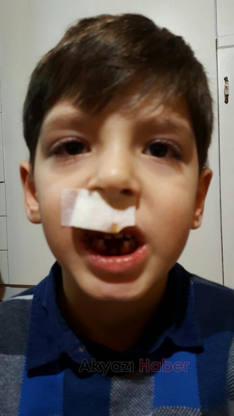 Küçük Çocuğun Dişleri Damağından Çıktı 