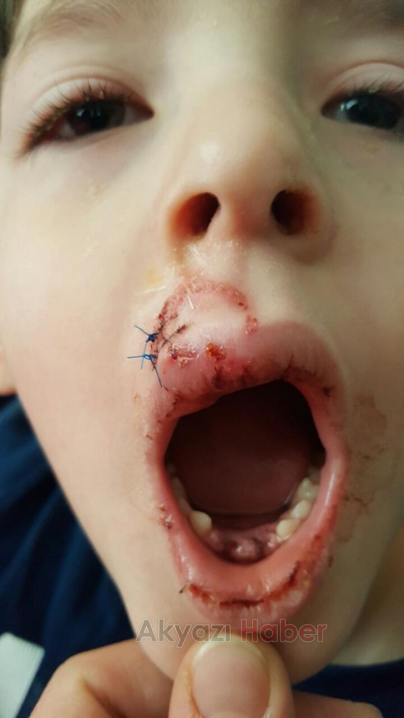 Küçük Çocuğun Dişleri Damağından Çıktı 
