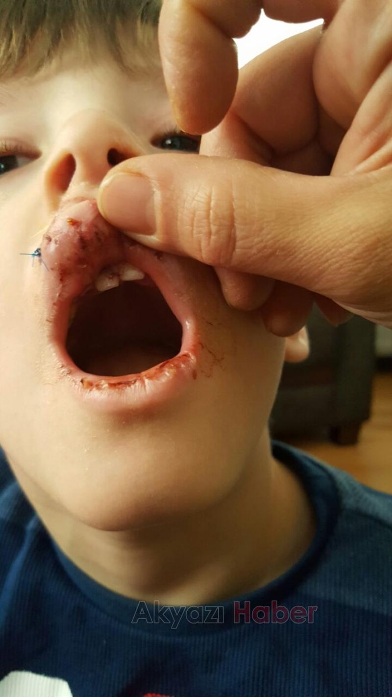 Küçük Çocuğun Dişleri Damağından Çıktı 