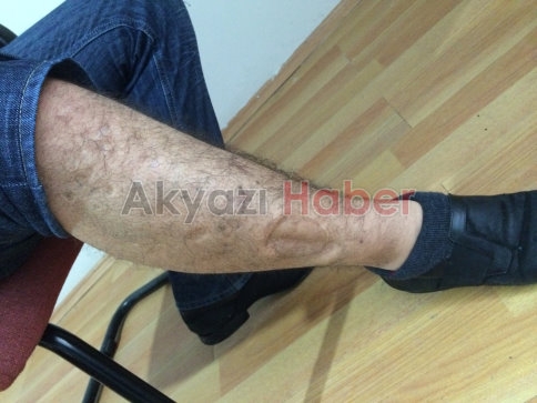 Bacağındaki şarapnel parçasının çıkarılmasını bekliyor