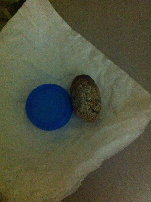 Safra Kesesinden Ceviz Büyüklüğünde Taş  Çıktı