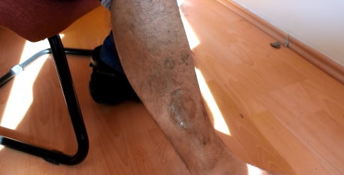 6 Yıl sonra Bacağında Şarapnel parçası çıktı 