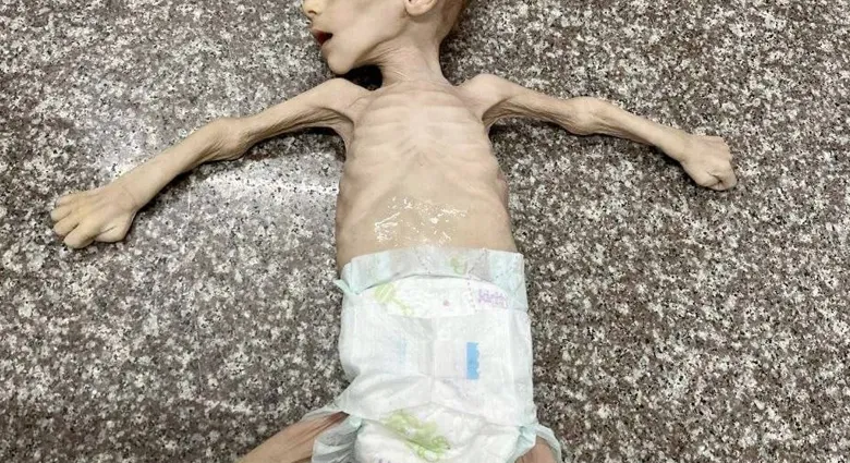 Gazze’de Açlıktan Ölümler Artıyor: 147 Can Yitip Gitti
