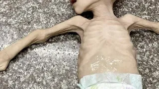 Gazze’de Açlıktan Ölümler Artıyor: 147 Can Yitip Gitti