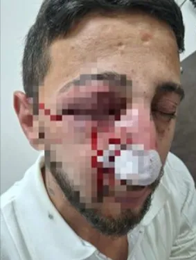 Havai fişek elinde patladı, gözünü kaybetti