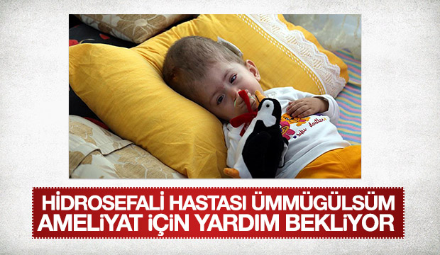 Hidrosefali hastası Ümmügülsüm ameliyat için yardım bekliyor