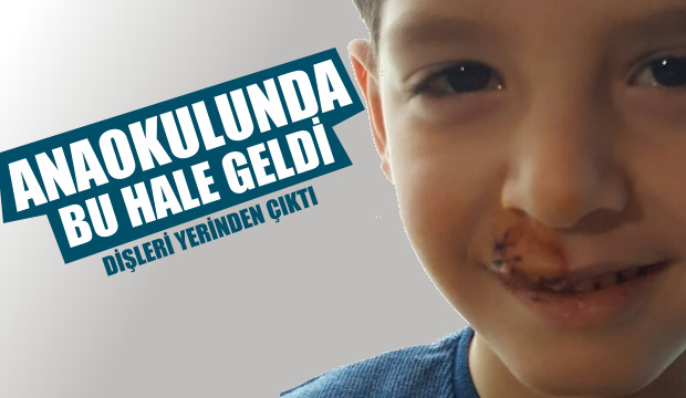 Küçük Çocuğun Dişleri Damağından Çıktı 