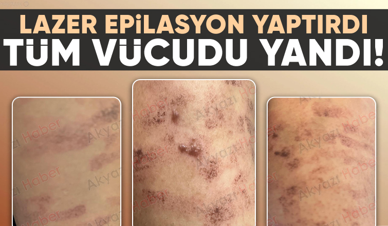 Lazer epilasyonda vücudu yandı