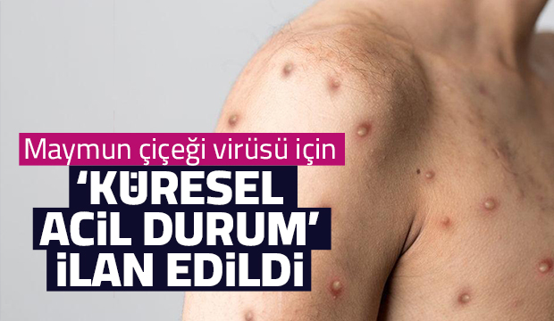 Maymun çiçeği için acil durum