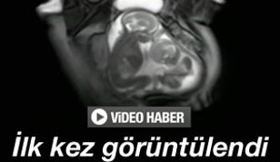 İkiz bebeklerin anne karnında kavgası - Video 