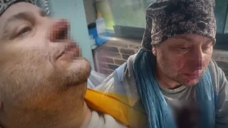 Pitbull saldırısına uğrayan ünlü sanatçı entübe edildi; Et yiyen bakteri şüphesi