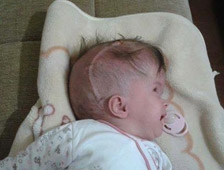 Hidrosefali hastası çocuğun ailesi yardım bekliyor