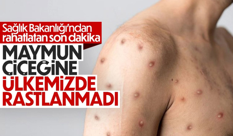 Sağlık Bakanlığı: Ülkemizde maymun çiçeği vakası görülmemiştir