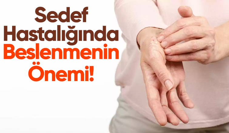 Sedef Hastalığında Beslenmenin Önemi!