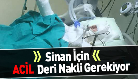 Sinan İçin ACİL Deri Nakli Gerekiyor