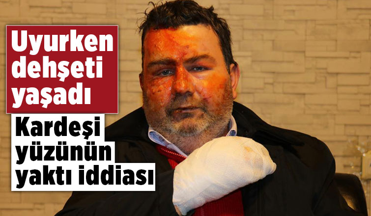 Uyurken yüzünü yaktı