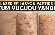 Lazer epilasyonda vücudu yandı